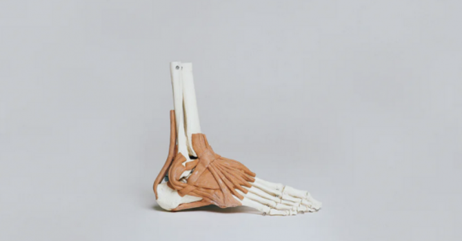 How Much Do You Know About Plantar Fasciitis? image